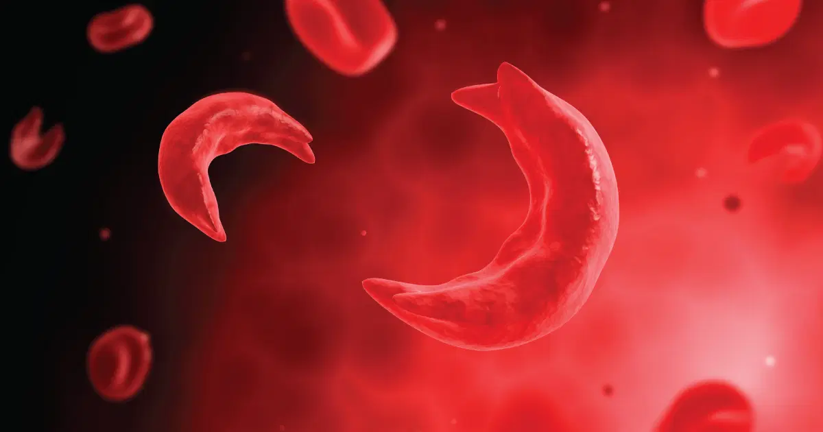 sicklecells